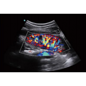 CHISON SonoAir™ 30 Portable Ultrasound System CHISON SonoAir™ 30 Portable Ultrasound System
