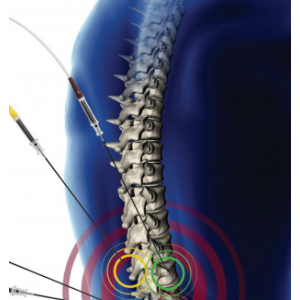 Diros OWL® Multi-Lesion Adaptor (MLA-4)