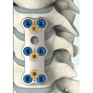 Sistem Plat Servikal Anterior ReBorn Essence (ReBorn Essence Anterior Cervical Plate System)