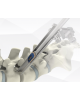 Sangkar Ti-PEEK CANIS oleh BAUI Spine Sangkar Ti-PEEK CANIS dengan struktur titanium berliang dan PEEK