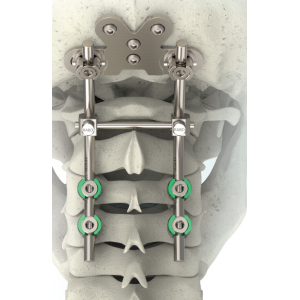Sistem Fiksasi Serviks Posterior ReBorn Essence®