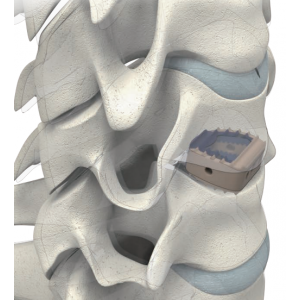 Sangkar Intervertebra Serviks ReBorn Essence® Venus