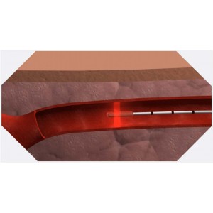 Eufoton High Focused (HF) Ring Fibers | Prime Medical Concept 具备圆润锥形尖端和 360 度径向激光光斑发射的 Eufoton High Focused HF Ring Fiber 探头