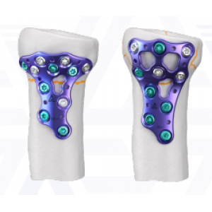 Sistem Plat Kepala Radial Siku AGOMED Panda (AGOMED Panda Elbow Radial Head Plates System)