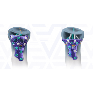 Plat Kepala Radial AGOMED Panda - Diedarkan oleh Prime Medical Concept Plat Rim dan Buttress AGOMED Panda Bersama Skru Titanium