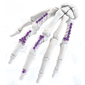 Sistem Plat Tangan AGOMED Panda (AGOMED Panda Hand Plating System)