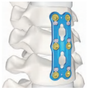 DEAN STRONG Anterior Cervical Plate System