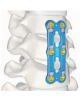 DEAN STRONG Anterior Cervical Plate System Malaysia DEAN STRONG Anterior Cervical Plate System