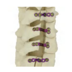 DEAN STRONG Anterior Cervical Plate System Malaysia DEAN STRONG Anterior Cervical Plate System