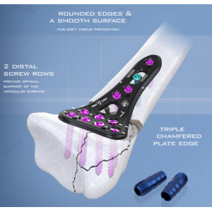 AGOMED King Kong Plating System 2.5 - Titanium Distal Radius & Ulna Plates and Screws Set