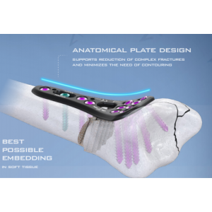AGOMED King Kong Plating System 2.5 - distributed by Prime Medical Concept AGOMED King Kong 2.5 Titanium Volar Plate and Multidirectional Locking Screws