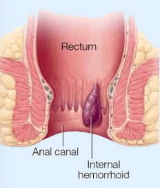 Internal Hemorrhoid